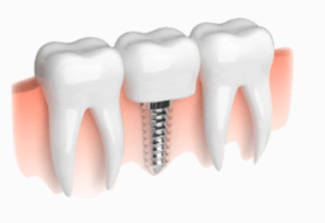 Diş implantları təhlükəlidir, ya əlverişli?